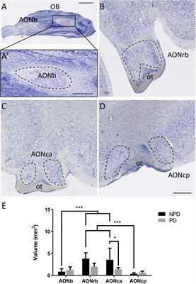 Neuronal and glial characterization in the rostrocaudal axis of the human anterior olfactory nucleus: Involvement in Parkinson’s disease